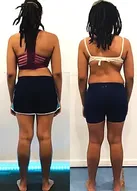 Baltimore-Physical-Therapist-scoliosis-approach-back-view-2.jpg